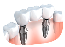 インプラント治療は治療前の準備が大切だと考えています。