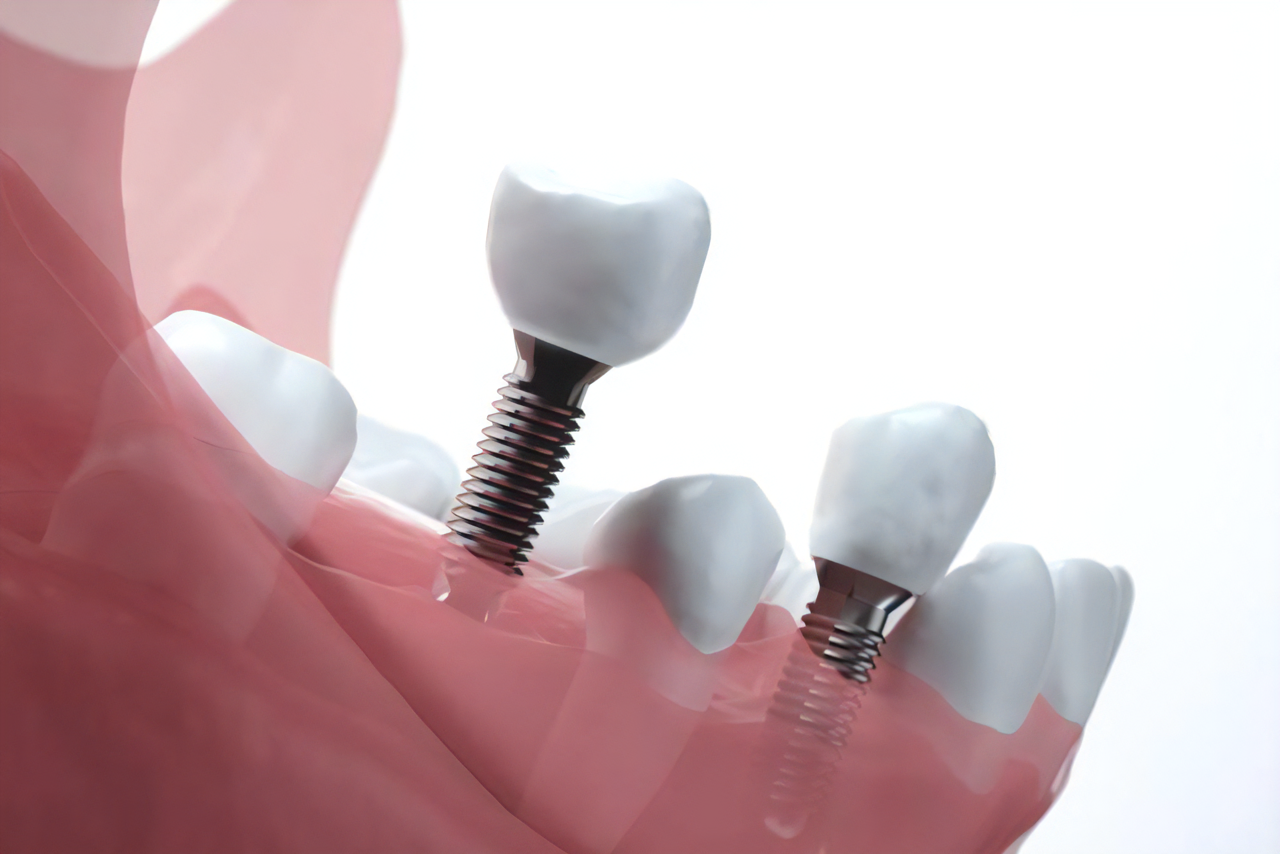 インプラント