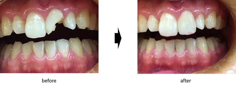 院長が得意としているグラディアダイレクト