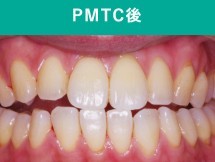 歯石除去後