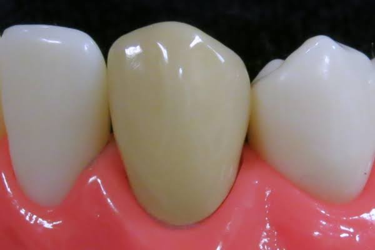 口元のストレスを解消する審美歯科