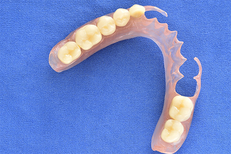 ノンクラスプデンチャーの一例