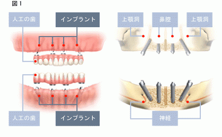 オール・オン・フォーによるインプラントを推奨します