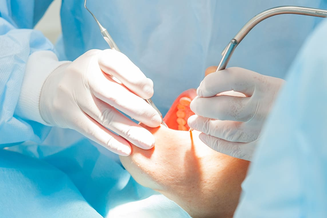 質の高いインプラント治療を提供します：やぎ歯科のインプラント治療