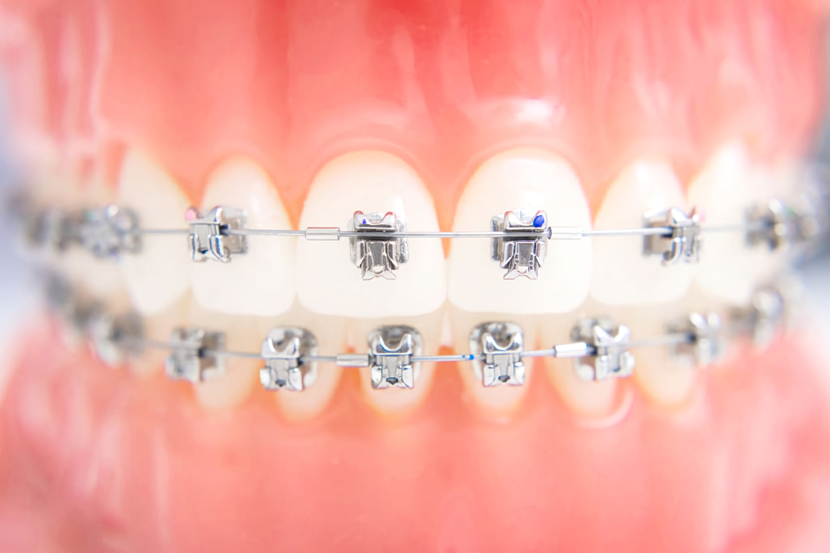 成長に合わせた小児矯正にも対応