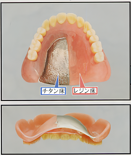 チタン製の入れ歯は様々な利点があります