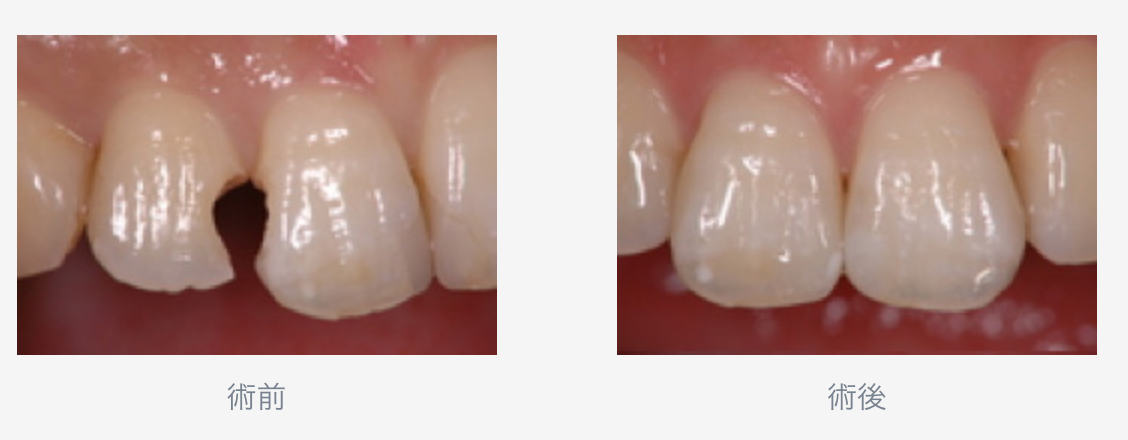 患者様の症状に合わせた被せ物や詰め物をご提案いたします