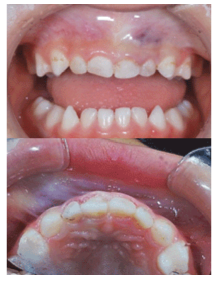 適切なむし歯治療を提供します