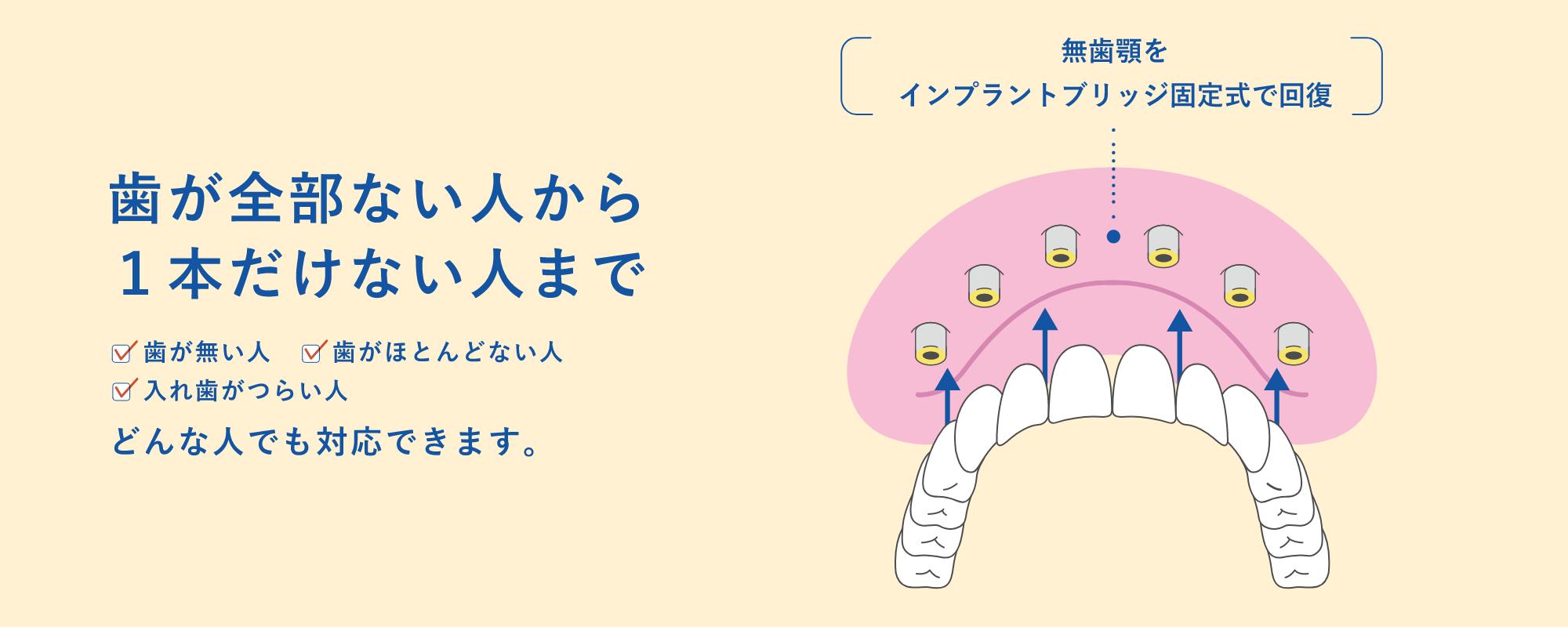幅広く対応するインプラント