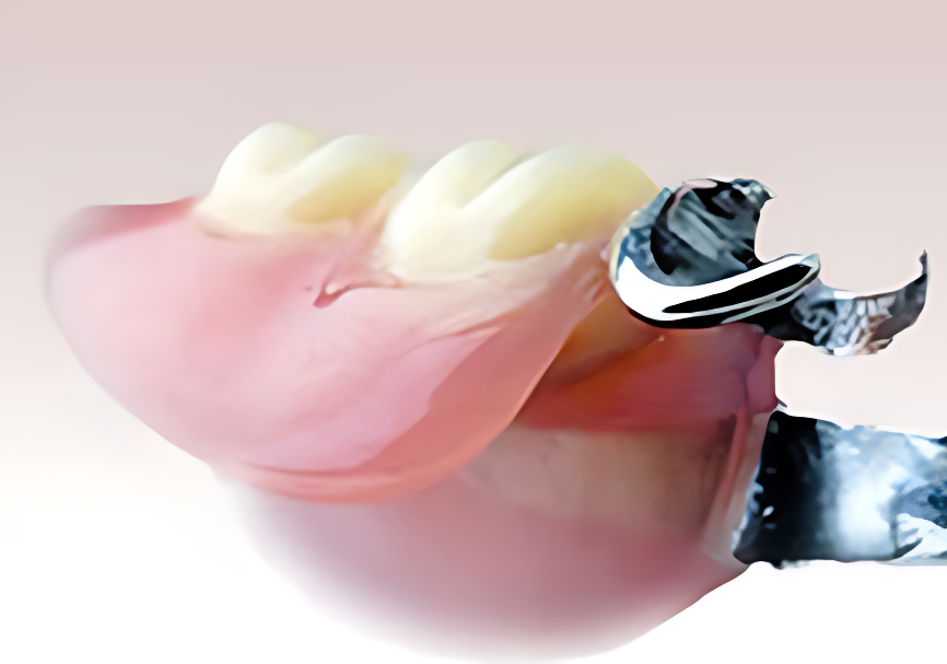 金属床部分入れ歯とハイドロキャスト法総入れ歯で長期的な満足を提供