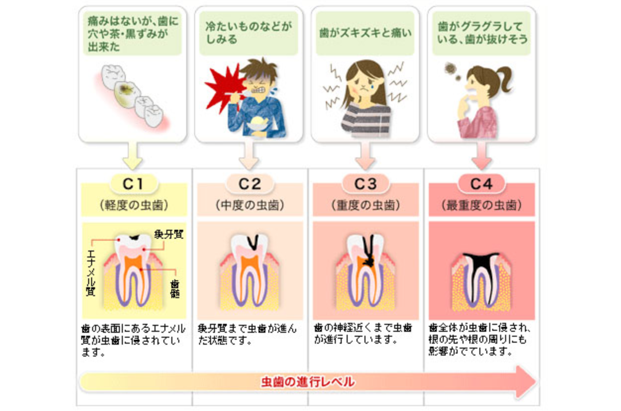 虫歯の進行度に応じた適切な治療方法を提案しています