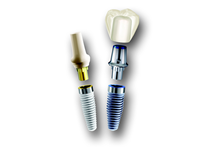入れ歯と異なり、周囲の歯に負担をかけずに、安定した咀嚼力を取り戻せる点が大きな特長です