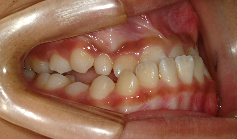 受け口は、顎関節や奥歯に強い力が加わってしまいます。