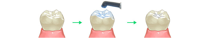 「シーラント」という予防処置を行っています