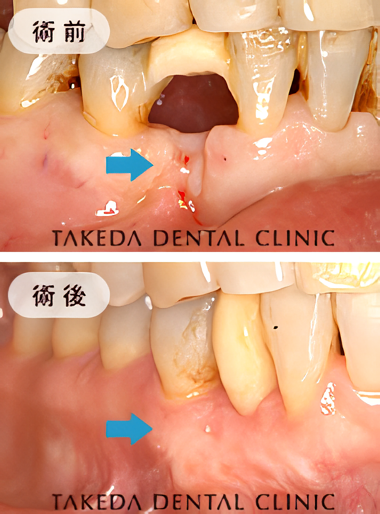 歯が抜けた部分の歯肉が大きく凹んでしまった症例です