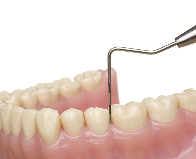 歯周病治療