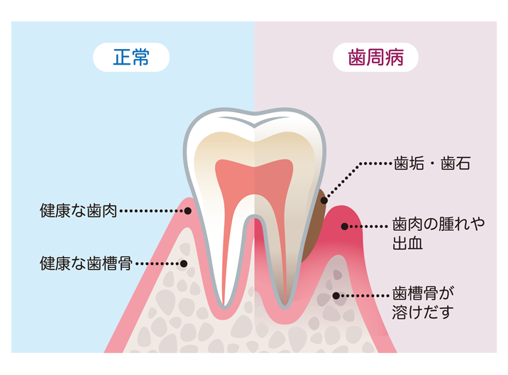 歯周病は重症化すると骨が溶けてしまいます