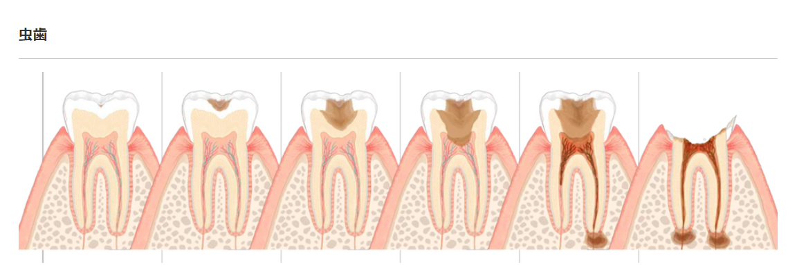 虫歯にならない口腔環境が大切です。
