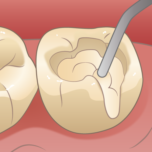 白い詰め物で目立たない治療が目指せます
