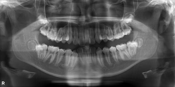 お子様一人ひとり成長や顔立ちが異なるため、装置や開始時期を含めたオーダーメイドの治療計画を立てています。