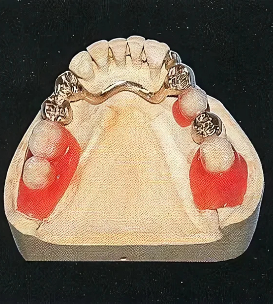 コーヌスクローネデンチャーは審美性にも優れています