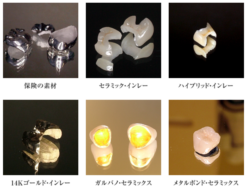 修復材料は10種類以上ご用意しています