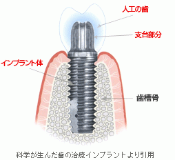 最新のインプラント治療で、失った歯を取り戻しましょう