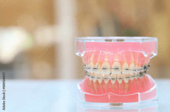 マルチブラケット法の目立ちにくい装置