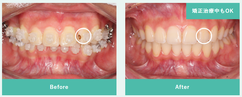 矯正装置を取り外すことなくむし歯治療が可能です