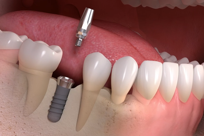 インプラント治療