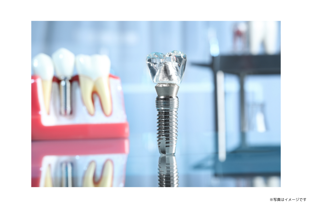 身体への負担軽減に配慮したインプラント治療を行っています