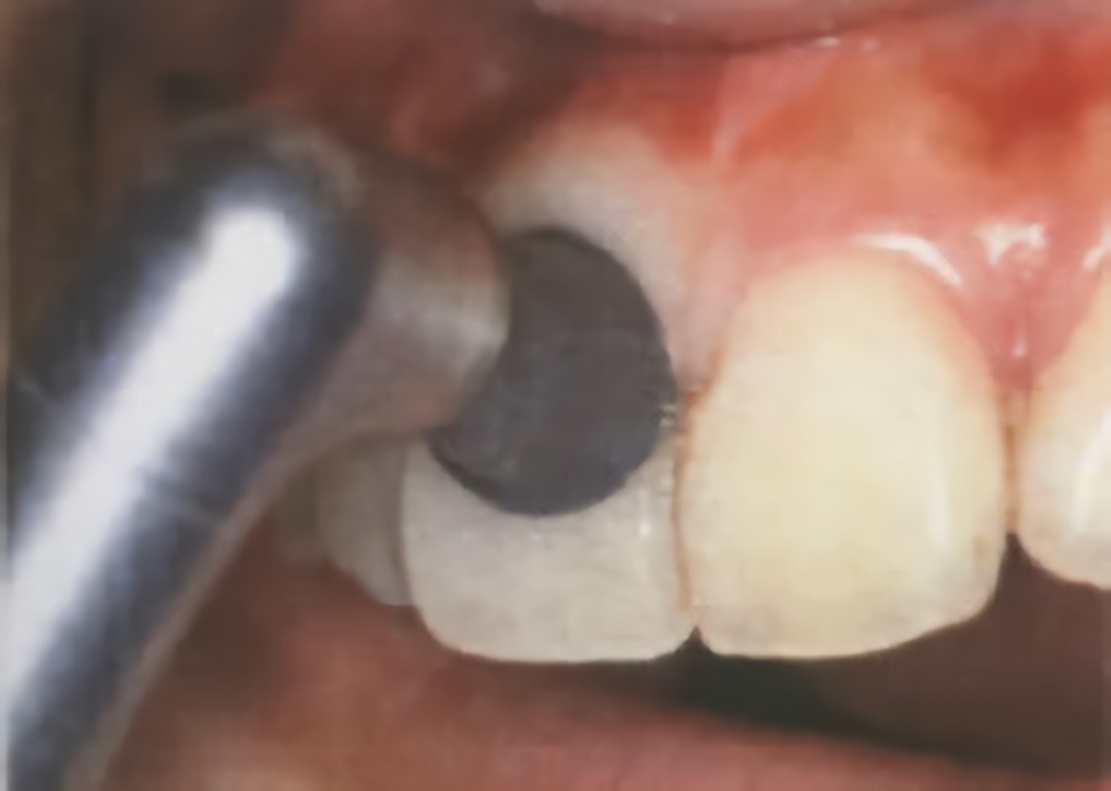 PMTCをおすすめします