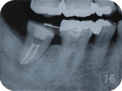 歯を失った際の選択肢
