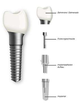 自然の歯に近い完成度