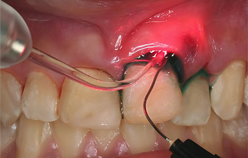 専門医によるレーザーを活用した歯周病治療