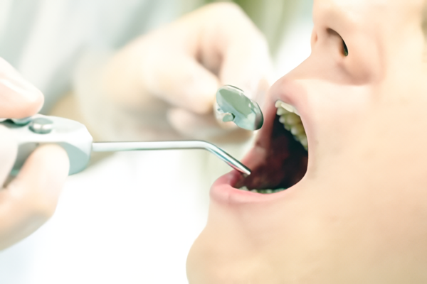 初期虫歯は削らず治す