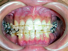 セラミックブラケットは、目立ちにくさと機能性の両立を求める方に適した治療法です。