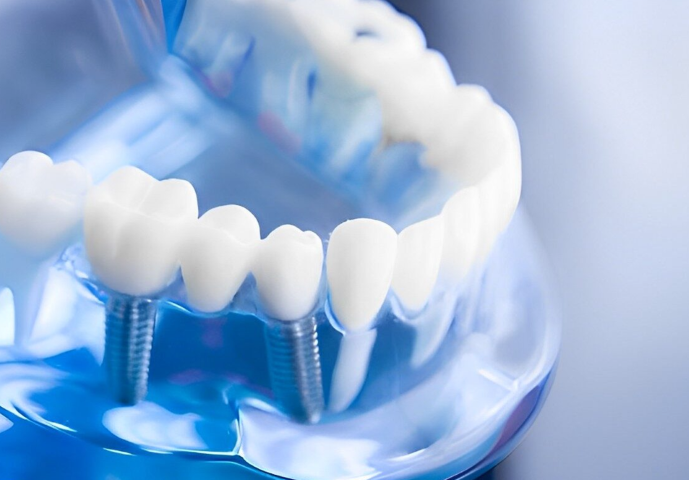 安心と技術を両立した精密なインプラント治療