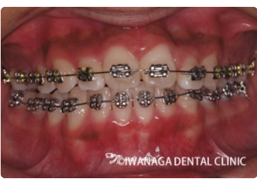 岩永歯科医院の歯科矯正装置（メタルブラケット）