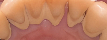 患者様に適切なプラークコントロールの方法をお伝えします