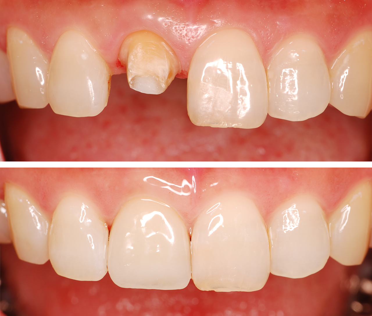 白い歯で自信の笑顔に