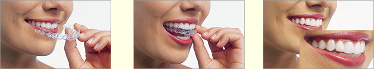 患者様一人ひとりの歯に合わせて作製された透明なアライナーを使用します