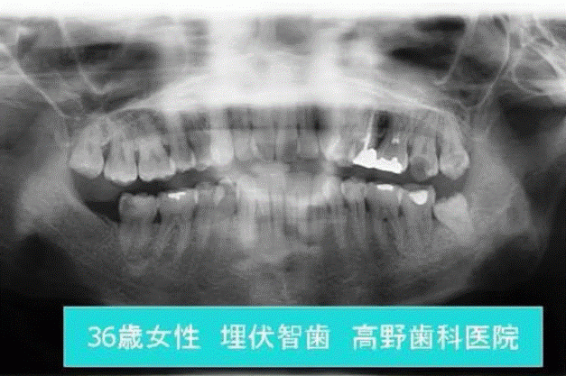 親知らずの抜歯から口腔内の嚢胞や腫瘤の治療まで、幅広い症例に対応しています。