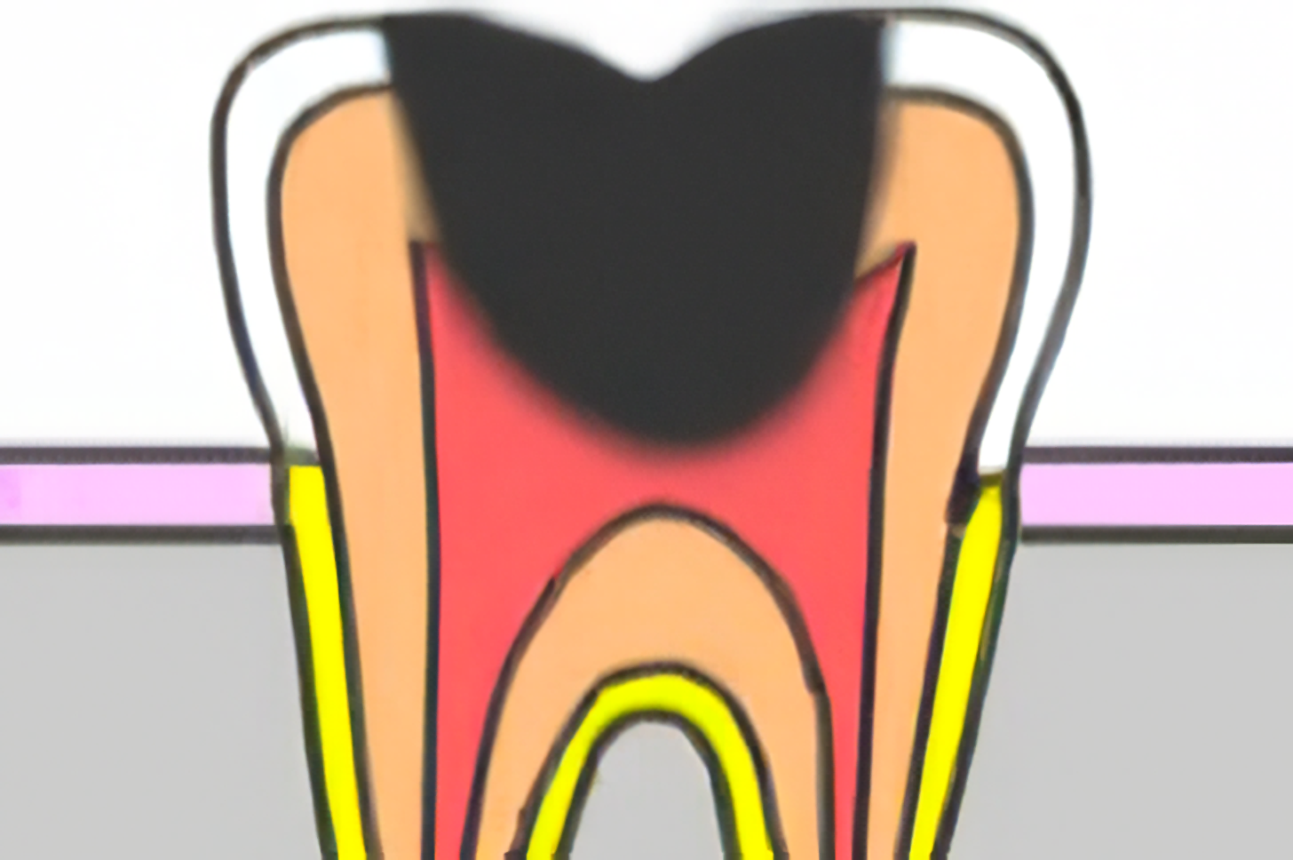 神経まで達した虫歯に対して行われます