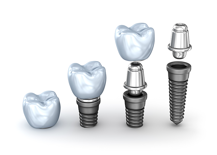 専門医によるインプラント治療
