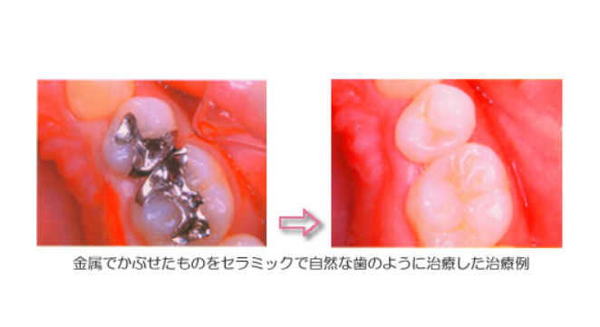 自然な仕上がりのセラミック