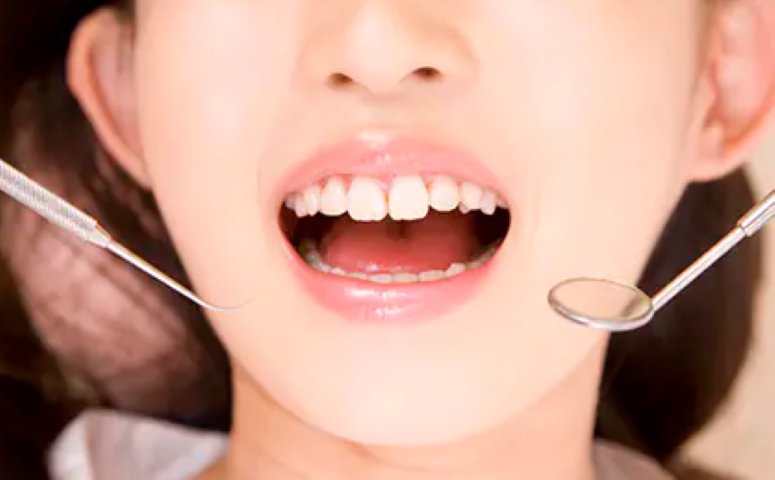 自然な白さで笑顔に自信を