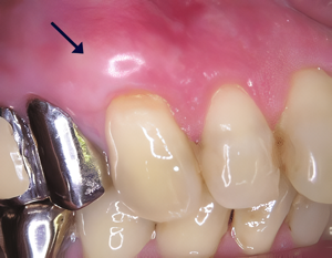 歯周病でやせてしまった歯ぐきのお悩みはご相談ください
