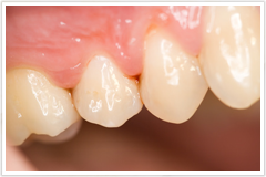 歯周病の診断と治療は日本臨床歯周病学会認定医が担当し、適切な治療を行います