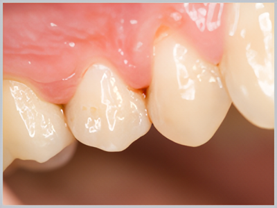 歯が無い方でも口腔ケアは重要です